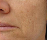Patient # 94134 After Photo # 2